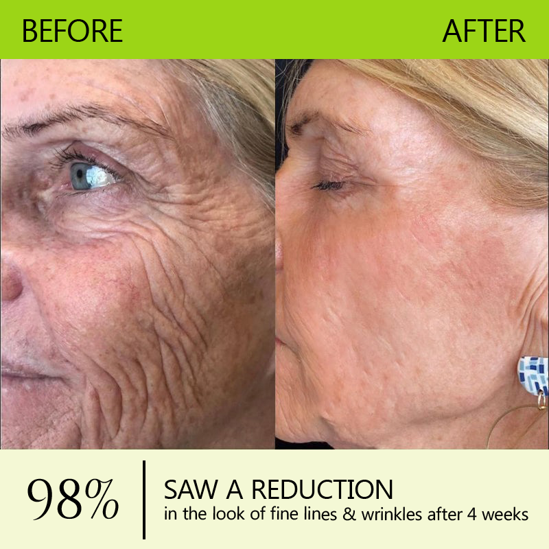 👩‍⚕️Made and shipped from NZ 🛒Healrize® Botox & Vita-A Retinol Shot Wrinkle-Lift Tightening cream - Last Day Promotion 70% OFF🛒