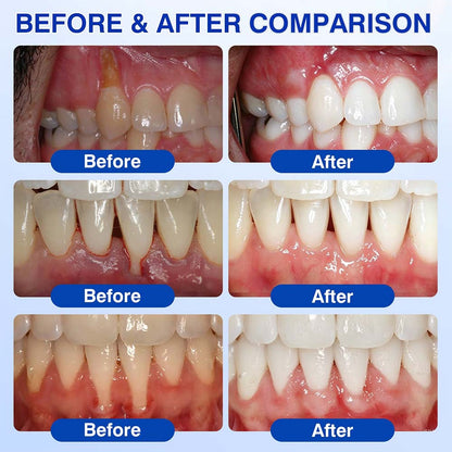🦷Healrize® GumRevive gel for the regeneration of the tooth-supporting apparatus (for bleeding gums, receding gums, and loose teeth)🎁