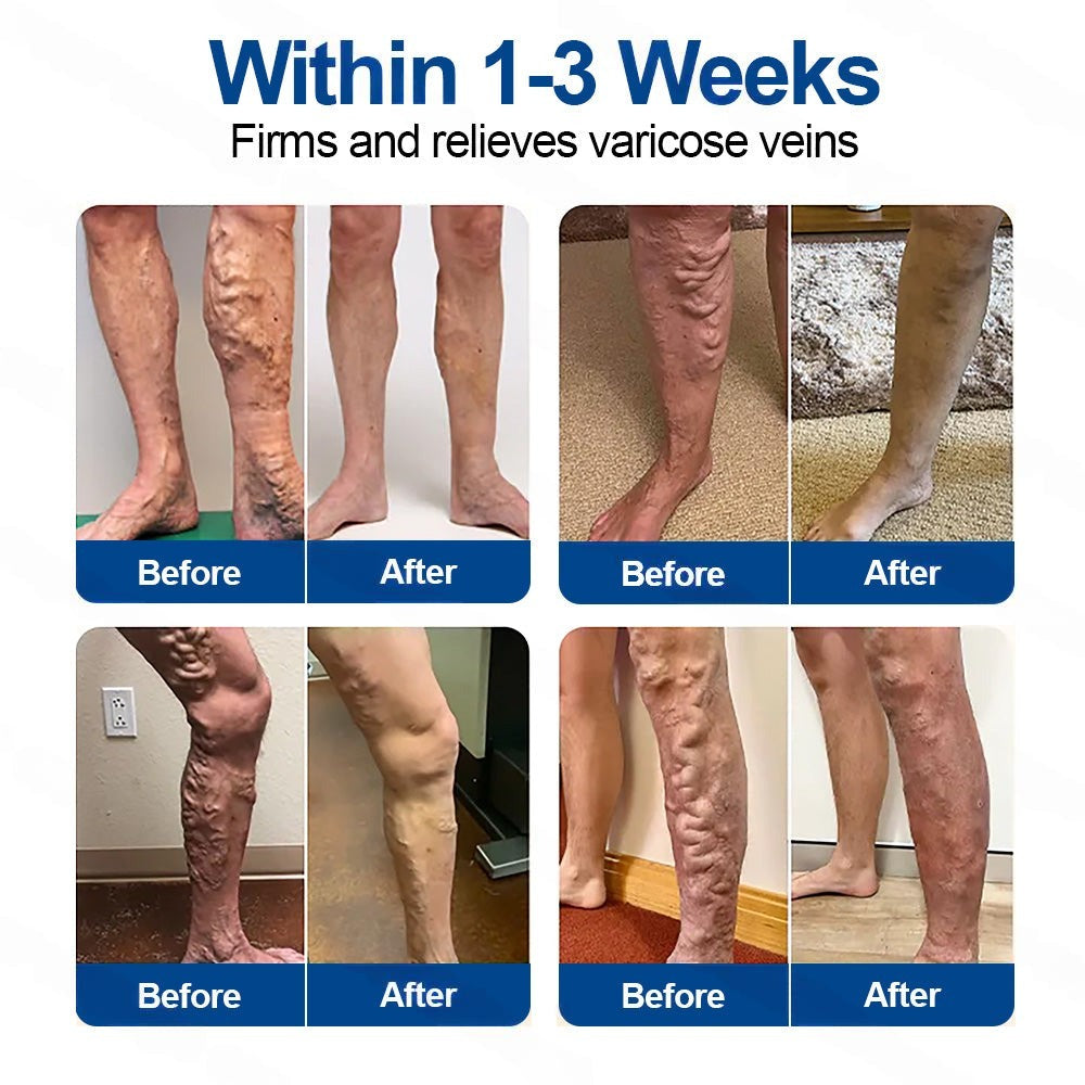 🇳🇿👨‍⚕️👍✅Healrize® VeinTarget Microneedle Patch🎖️Instant Relief, Long-Term Results 🎖️
