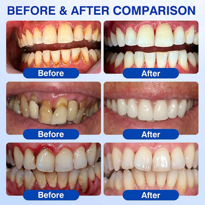 🦷Healrize® GumRevive gel for the regeneration of the tooth-supporting apparatus (for bleeding gums, receding gums, and loose teeth)🎁